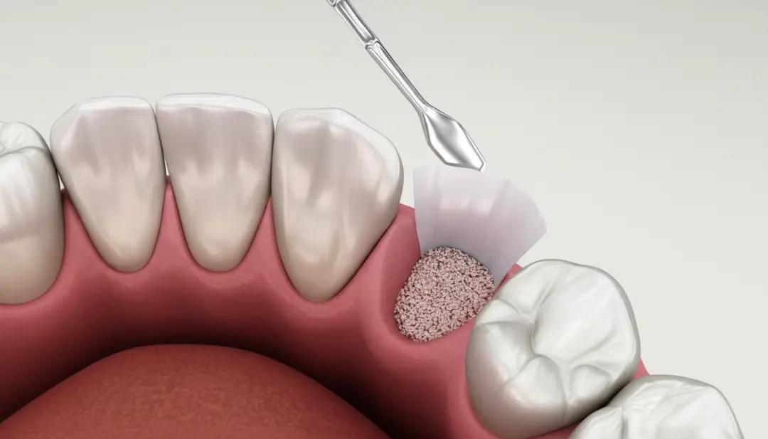 Bone Grafting-Oral Surgery by Valley View Dental