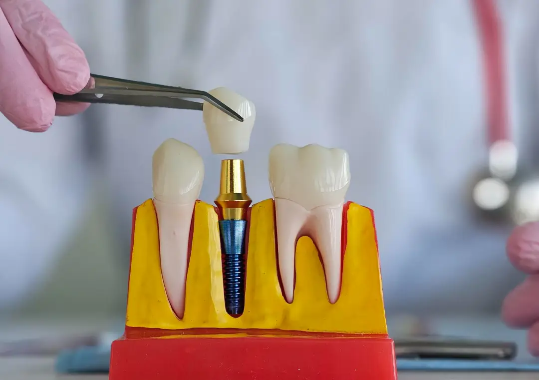 CEREC Same-Day Crowns-Advanced Dentistry by Valley View Dental