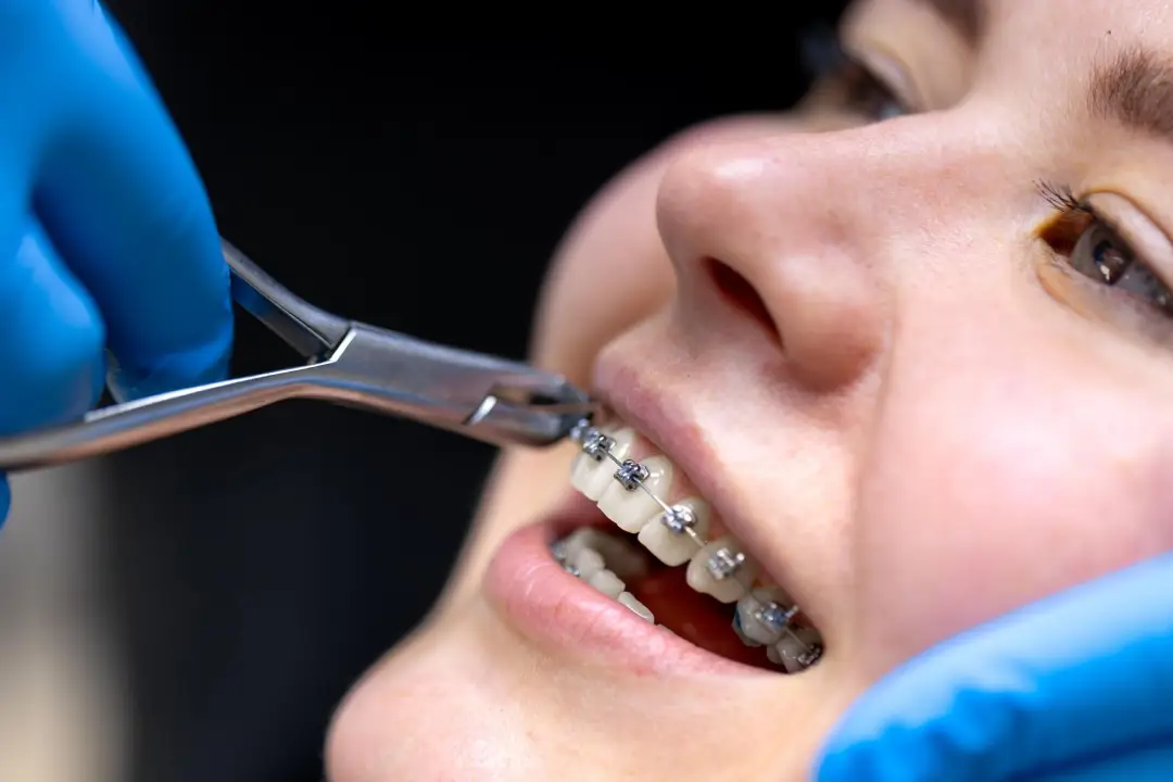 Traditional Braces-Orthodontics by Valley View Dental